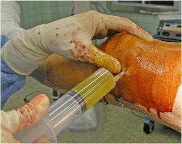 This clinical photograph captures a knee arthrocentesis (joint aspiration) being performed in an operative setting. A gloved healthcare provider is seen inserting a needle into the distended suprapatellar space of a patient's knee, which has been prepped with a povidone-iodine antiseptic solution. The procedure has successfully extracted a significant volume of synovial fluid into a large-bore syringe. The fluid exhibits a distinct yellow-amber color and a turbid (cloudy) appearance, which is a key diagnostic indicator. Such macroscopic findings typically suggest an inflammatory process, such as rheumatoid arthritis, gout, or pseudogout (calcium pyrophosphate deposition disease), rather than normal, clear, straw-colored synovial fluid. The image serves as an educational tool for demonstrating the technique of joint aspiration in the context of postoperative knee effusion and the clinical assessment of synovial fluid clarity and color for differential diagnosis in orthopedics and rheumatology.