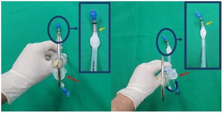 A clinical comparison photograph demonstrating the rotatory maneuver for inserting a left-sided double-lumen endotracheal tube (DLT). The image consists of two panels (left and right) showing a gloved hand holding a DLT with an internal rigid J-shaped stylet against a green surgical drape. In the left panel, the tube is shown in its initial orientation: the bronchial lumen and stylet tip are aligned anteriorly (12 o'clock position), while the proximal (red arrow) and distal (yellow arrow) tracheal lumen orifices are oriented posteriorly. The right panel illustrates the 90-degree counterclockwise rotation maneuver typically performed as the bronchial tip passes through the vocal cords. Post-rotation, the tracheal orifices are re-positioned to the lateral (right-side) orientation. Blue circular highlights and inset magnifications emphasize the tip's spatial relationship. This visual serves as an educational guide for anesthesiology residents and clinical staff on proper DLT manipulation techniques during thoracic surgery intubation procedures to ensure correct anatomical placement into the left mainstem bronchus.