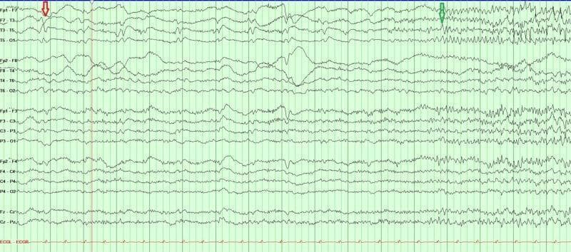 This diagnostic image shows a multi-channel continuous electroencephalogram (EEG) tracing used to monitor brain electrical activity. The tracing demonstrates the evolution of focal epileptiform activity into a generalized seizure. A red arrow on the left side of the tracing identifies interictal epileptiform discharges, specifically sharp waves, localized to the left temporal region (prominent in channels F7-T3, T3-T5, and T5-O1). A green arrow toward the right indicates the electrographic onset of a seizure, characterized by a transition from the background rhythm to rhythmic, high-frequency, and high-amplitude discharges. This ictal pattern shows rapid alpha and beta frequency activity that originates in the left temporal channels before demonstrating focal spread. The tracing is displayed on a standard green grid, providing a visual representation of status epilepticus and the transformation from focal sharps to rhythmic seizure activity, essential for neurocritical care and epilepsy diagnostics.