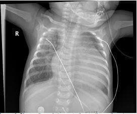 This diagnostic image is an anteroposterior (AP) pediatric chest radiograph demonstrating significant cardiomegaly and signs of pulmonary congestion. The cardiac silhouette is markedly enlarged, occupying a substantial portion of the thoracic cavity, which is indicative of cardiac dysfunction or congenital heart disease. The lung parenchyma exhibits diffuse interstitial prominence and hazy opacities, characteristic of pulmonary interstitial edema. Multiple medical devices are visible, including external monitoring leads and an enteric tube. The radiographic findings are clinically significant for evaluating pediatric patients presenting with respiratory distress or suspected cardiogenic shock, such as that seen in Shone complex or other left-sided obstructive lesions. The image serves as a critical educational tool for identifying neonatal/infant cardiomegaly and secondary pulmonary vascular congestion in a critical care or emergency setting.