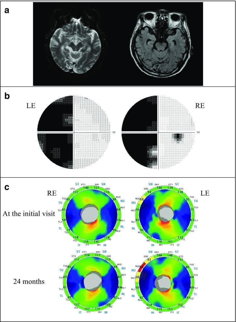 This composite educational graphic illustrates the neuro-ophthalmological findings of trans-synaptic retrograde degeneration following an occipital lobe stroke. Panel (a) displays axial MRI sequences (DWI and FLAIR) showing a hyperintense ischemic lesion in the right posterior cerebral artery territory. Panel (b) presents Humphrey visual field (HVF) plots demonstrating a dense left homonymous hemianopia with macular splitting. Panel (c) features Spectral-Domain Optical Coherence Tomography (SD-OCT) significance maps for the circumpapillary retinal nerve fiber layer (cpRNFL) thickness at the initial visit (top) and at 24-month follow-up (bottom). The OCT maps show the evolution of sectoral thinning, specifically in the nasal sectors of the left eye (contralateral to the lesion) and temporal sectors of the right eye (ipsilateral to the lesion), corresponding to the hemianopic defect. Comparison between the initial and 24-month maps highlights the longitudinal progression of thinning in the superior nasal (SN), inferior temporal (IT), and temporal upper/lower (TU/TL) sectors, a hallmark of retrograde axonal loss after primary cortical injury.