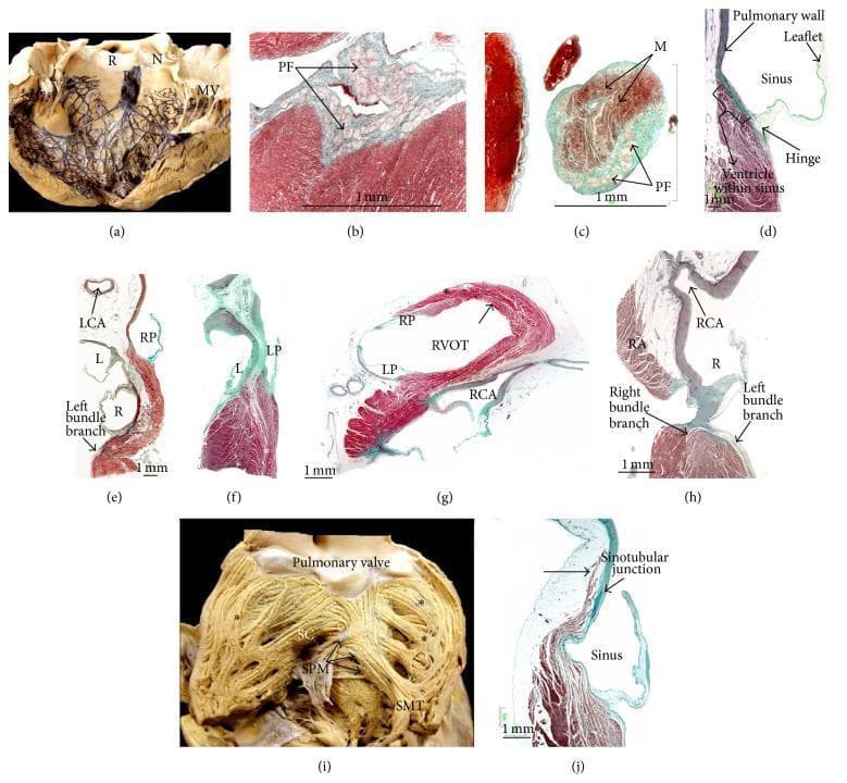 This composite educational resource details the cardiac conduction system and ventricular anatomy through gross clinical photographs and histological sections. Figure (a) displays a bovine heart with Indian ink highlighting the left bundle branch and dense Purkinje network branching around the aortic sinuses (R, N) and mitral valve (MV). Figures (b) and (c) are Masson's trichrome-stained sections showing Purkinje fibers (PF) as distinct light-colored structures within the subendocardial matrix and false tendons. Figures (d), (g), and (j) illustrate the histology of the pulmonary valve, highlighting the hinge attachment to the ventricular myocardium and fiber orientation within the right ventricular outflow tract (RVOT). Sagittal sections (e, f, h) demonstrate the anatomical relationships between the right atrium (RA), aortic root, and conduction tissue, specifically the right and left bundle branches near the right coronary artery (RCA). Figure (i) provides an endocardial view of the RVOT, showing the septomarginal trabeculation (SMT) and supraventricular crest (SC). These materials illustrate the structural basis for electrical propagation and the anatomical proximity of conduction pathways to valvar structures.
