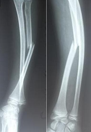 This diagnostic image displays two X-ray views (anteroposterior and lateral) of a pediatric forearm demonstrating a classic Galeazzi fracture-dislocation. The radiograph reveals a complete, displaced fracture of the mid-to-distal third (diaphysis) of the radius bone. Significant lateral and posterior angulation of the proximal radial fragment is visible, along with overriding of the fracture ends. Accompanying this radial injury is a clear disruption of the distal radioulnar joint (DRUJ), characterized by the loss of normal anatomical alignment between the distal radius and the ulnar head at the wrist. The presence of open growth plates (physes) at the distal radius and ulna indicates the skeletal immaturity of the patient. This visual serves as a primary educational example of how a solitary radial shaft fracture necessitates close evaluation of the distal radioulnar joint to identify associated ligamentous instability or luxation, critical for orthopedic trauma management and surgical planning.