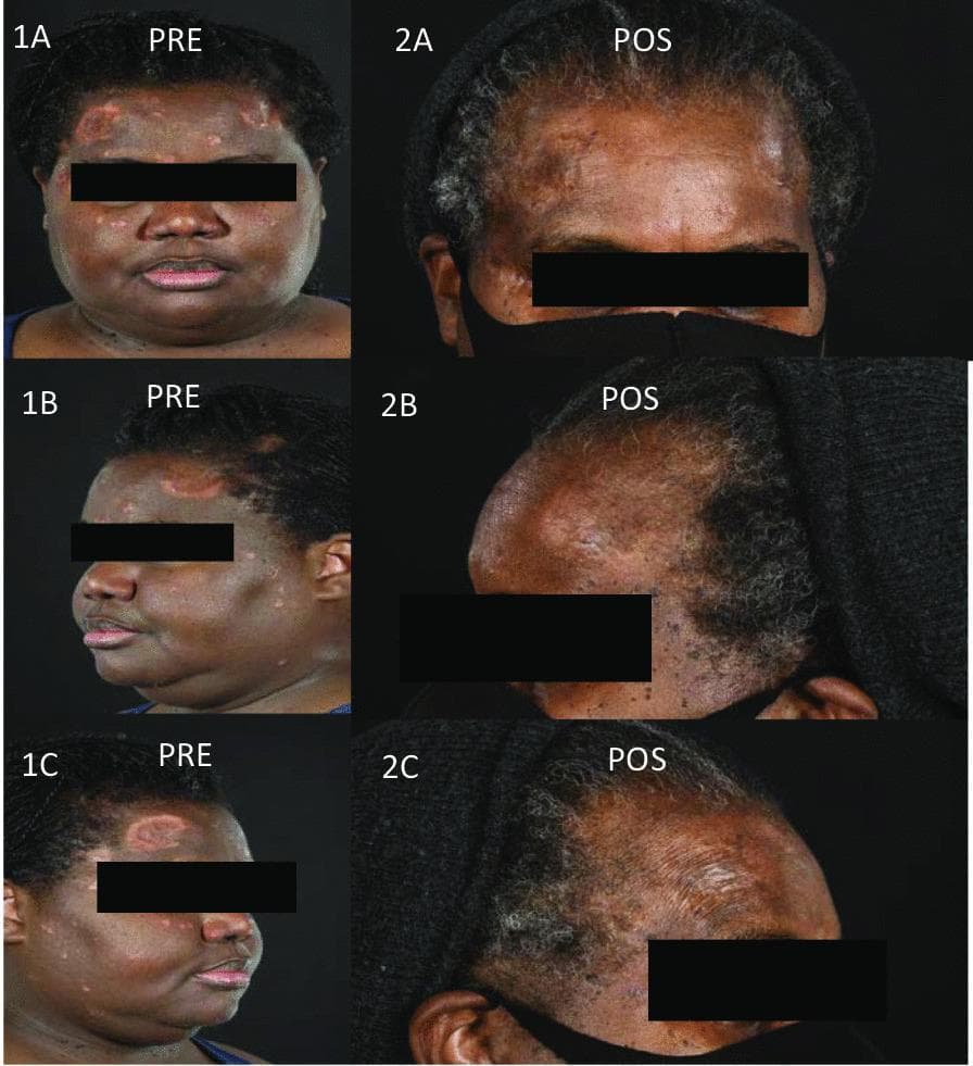 A series of clinical photographs (comparison chart) documenting a case of cutaneous sarcoidosis before and after treatment with infliximab. The pre-treatment images (1A-1C) show a patient with dark skin tones presenting with multifocal, well-demarcated annular lesions, erythematous papules, and indurated plaques. These lesions are primarily distributed across the forehead, temples, and scalp margin, exhibiting central atrophy, scarring, and a mottled pattern of hyperpigmentation and hypopigmentation. The post-treatment images (2A-2C) demonstrate significant clinical improvement. There is a visible resolution of the active inflammatory plaques and papules, leading to a flattened skin surface. However, residual post-inflammatory hypopigmentation and areas of dermal atrophy remain at the sites of the previous active sarcoidosis. The images illustrate the effectiveness of biologic therapy (anti-TNF) in managing recalcitrant cutaneous manifestations of sarcoidosis and the potential for long-term pigmentary and structural skin changes following disease resolution.