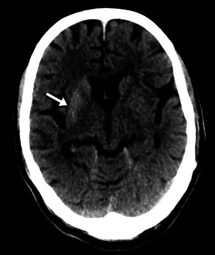 This diagnostic image is an axial non-contrast computed tomography (CT) scan of the brain. The primary finding is a localized area of hyperdensity within the right basal ganglia, specifically involving the caudate nucleus and putamen, as indicated by the white arrow. Despite this abnormal density, there is preserved gray-white matter differentiation elsewhere in the cerebral parenchyma. Crucially, there is no evidence of surrounding vasogenic edema, midline shift, or mass effect on the adjacent ventricular system. The intracranial space appears free of acute hemorrhage, and the skull vault remains intact. This radiological presentation is characteristic of non-ketotic hyperglycemic hemichorea (NHH), demonstrating the classic unilateral hyperdensity of the striatum on CT. The image serves as an educational example of how metabolic derangements can manifest as focal neuroradiological abnormalities without typical features of ischemia or space-occupying lesions.
