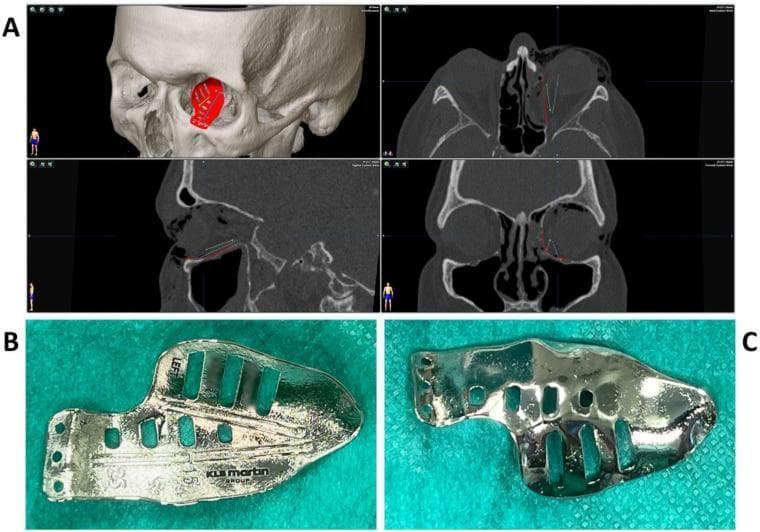 This composite educational image illustrates the pre-operative planning and physical characteristics of a Patient-Specific Implant (PSI) for complex orbital floor and medial wall reconstruction. Panel A displays a multiplanar diagnostic view, combining a 3D volume-rendered CT of the skull with axial, sagittal, and coronal cross-sections. The 3D view shows the red computer-aided design (CAD) of the implant positioned within the left orbit. The 2D views demonstrate the planned implant trajectories (indicated by blue and green lines) relative to the fracture site and surrounding sinus structures. Panels B and C provide clinical photographs of the titanium implant. Panel B shows the superior surface, featuring navigation grooves for intraoperative guidance and manufacturer markings. Panel C reveals the inferior surface, which has been treated with plasma electrolytic polishing (PeP) to create a smooth, biocompatible interface for the orbital bone. The implant includes multiple slots to facilitate tissue integration and drainage. This content is designed for oral and maxillofacial surgery education, focusing on digital surgical planning and implant surface engineering.