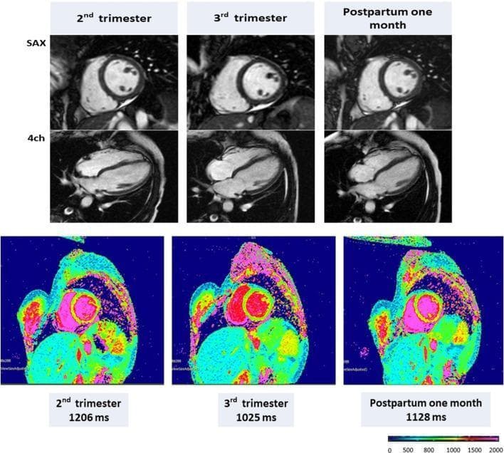 This cardiovascular magnetic resonance (CMR) comparison illustrates left ventricular (LV) remodeling and tissue characterization in a representative pregnant woman across three stages: 2nd trimester, 3rd trimester, and 1 month postpartum. The top rows feature structural cine images in short-axis (SAX) and four-chamber (4ch) views, demonstrating longitudinal changes in end-diastolic volume, ejection fraction, and LV mass. The bottom row presents native T1 mapping using the MOLLI (Modified Look-Locker Inversion recovery) sequence at 1.5 Tesla. These color-coded parametric maps represent myocardial T1 values, with a provided scale ranging from 0 to 2000 ms. Quantitatively, the native T1 values fluctuate from 1,206 ms in the 2nd trimester, decreasing to 1,025 ms in the 3rd trimester, and recovering to 1,128 ms postpartum. Visually, this is reflected in the shift from higher T1 areas (pink/yellow) to lower T1 regions (green/blue) and back. This visual comparison is educationally significant for understanding physiological cardiac adaptation during pregnancy and the role of non-contrast CMR in assessing myocardial tissue properties and peripartum cardiomyopathy (PPCM).
