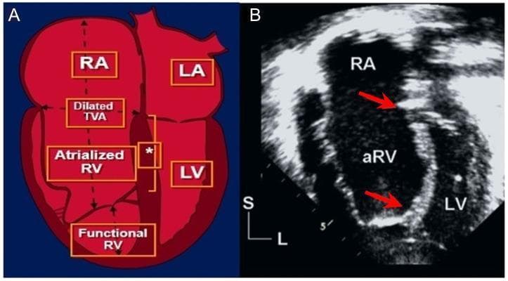 Educational panel illustrating Ebstein anomaly through a comparison of anatomical schematic (A) and diagnostic ultrasound (B). Figure A is a pathophysiology diagram showing apical displacement of the septal tricuspid valve leaflet, creating a tripartite right heart structure: the true right atrium (RA), an atrialized portion of the right ventricle (aRV), and a small functional right ventricle (RV). It highlights the dilated tricuspid valve annulus (TVA) and the characteristic large, sail-like anterior leaflet. Figure B is an apical 4-chamber echocardiogram during systole, showing the clinical manifestation of the anomaly. Red arrows delineate the displacement index—the distance between the mitral valve annulus and the apically displaced septal tricuspid leaflet. This measurement, when indexed to body surface area (>8 mm/m²), is a critical diagnostic criterion to distinguish Ebstein anomaly from other causes of right ventricular enlargement. Visible chambers include the massively dilated RA, the aRV, and the compressed left ventricle (LV).