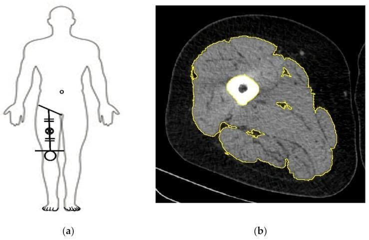This educational image demonstrates the methodology for measuring Cross-Sectional Muscle Area (CSMA) using Computed Tomography (CT). Panel (a) is a schematic diagram showing a human silhouette with landmarks for mid-thigh CT imaging, located at the midpoint between the inguinal crease and the proximal pole of the patella. Panel (b) is a diagnostic axial CT scan of the mid-thigh. The image highlights tissue differentiation based on Hounsfield units (HU). The central femur is depicted as a high-density (bright) circular structure. The skeletal muscles are manually segmented with yellow outlines to isolate the CSMA, effectively excluding subcutaneous fat, intermuscular fat (low-density/dark areas), and cortical bone. This visualization is used in clinical research to assess sarcopenia, frailty, and nutritional status by quantifying muscle mass and identifying intramuscular adipose tissue infiltration. The segmentation illustrates the anatomical boundaries between the quadriceps, adductors, and hamstring muscle groups.