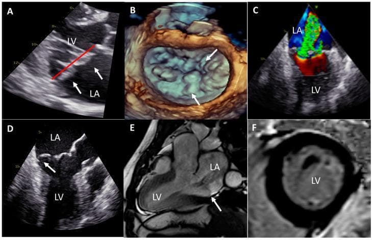 This multi-panel figure demonstrates multimodal clinical imaging of Barlow's mitral valve disease and associated cardiac remodeling. (A) Transthoracic echocardiography (parasternal long-axis) shows thickened, bileaflet mitral valve prolapse (white arrows) into the left atrium (LA) beyond the annular plane (red line). (B) 3D transesophageal echocardiography (TEE) 'surgeon's view' provides a detailed anatomical surface map of the multi-scallop, redundant leaflets characteristic of Barlow's disease. (C) TEE with color Doppler in a bicommissural view highlights a severe, multi-jet eccentric mitral regurgitation. (D) 2D TEE three-chamber view identifies posterior leaflet prolapse and the presence of mitral annular disjunction (MAD). (E) Cardiac magnetic resonance (CMR) three-chamber cine view confirms bileaflet prolapse, mild MAD, and a dilated left ventricle (LV). (F) Short-axis CMR late gadolinium enhancement (LGE) at the papillary muscle level shows no macroscopic myocardial fibrosis (black myocardium). The collection illustrates the diagnostic features of myxomatous valve degeneration, annular disjunction, and secondary ventricular dilatation across ultrasound and magnetic resonance modalities.
