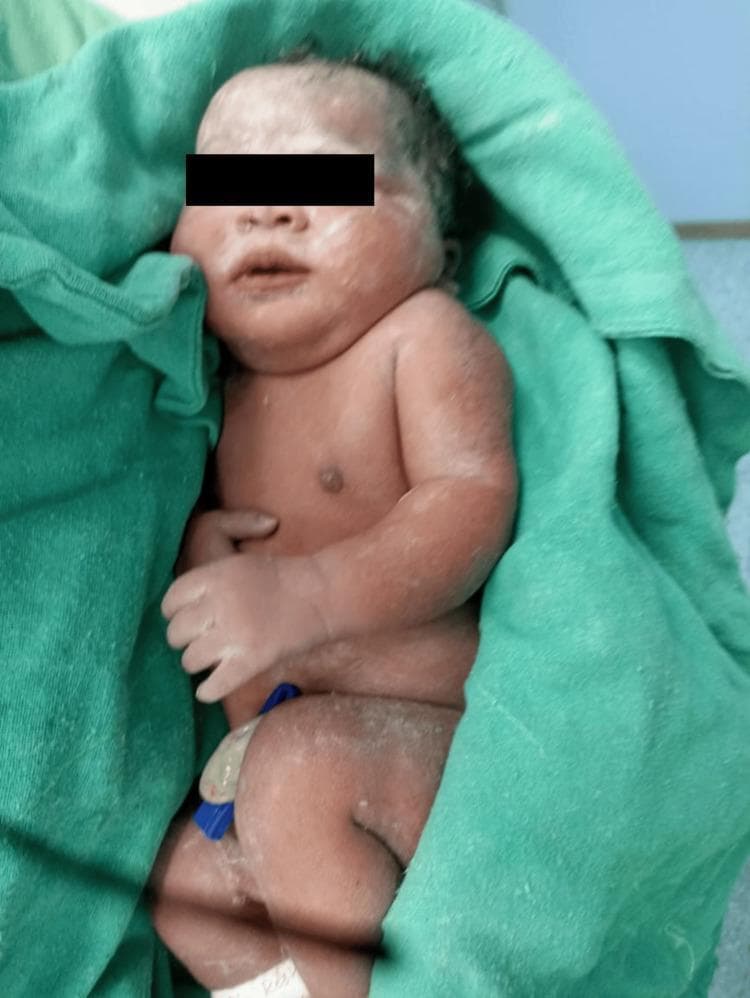 Clinical photograph of a newborn immediately following delivery, likely via cesarean section as indicated by the surgical setting. The infant presents with a healthy reddish skin tone (erythema neonatorum) and is partially covered in vernix caseosa, a protective white, creamy biofilm visible on the face, scalp, and limbs. The newborn is lying in a supine position on a green sterile surgical drape. Anatomical features include a flexed posture of the lower extremities and a blue plastic umbilical cord clamp applied to the umbilical stump. The face shows mild physiological edema common in neonates. This image serves as an educational example of immediate neonatal appearance and the outcome of obstetric anesthetic management. For patient privacy, the eyes are obscured by a black bar.