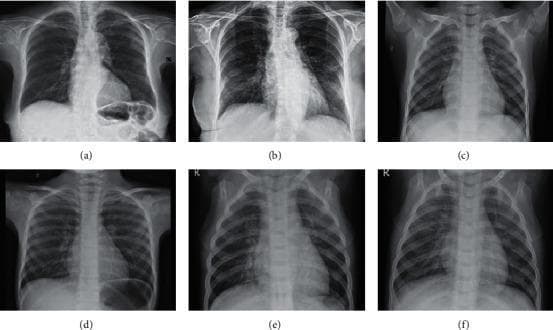 A comparative diagnostic display containing six posteroanterior (PA) chest X-ray radiographs labeled (a) through (f), categorized by pathological findings. Images (a) and (b) represent COVID-19 pneumonia, demonstrating bilateral ground-glass opacities and increased pulmonary density with ill-defined margins, characteristic of viral interstitial infiltrate. Images (c) and (d) represent normal controls, showing clear lung fields, well-defined vascular markings, and sharp costophrenic angles without evidence of consolidation or effusion. Images (e) and (f) depict other types of non-COVID pneumonia, showing varying degrees of focal consolidation and bronchovascular thickening. This comparison serves as a clinical imaging reference for differentiating viral pneumonia patterns from normal thoracic anatomy and other inflammatory lung conditions. The anatomical structures visible include the lungs, heart, rib cage, clavicles, and diaphragm, providing a comprehensive view of the thoracic cavity for radiological training and diagnostic classification.