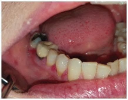 This clinical photograph shows an intraoral view of the lower right mandibular arch, demonstrating classic signs of desquamative gingivitis. The gingiva exhibits focal areas of intense erythema, particularly along the marginal and attached gingival tissues. These lesions represent desquamation or thinning of the epithelial surface, resulting in a raw, beefy red appearance. In addition to the soft tissue pathology, the image displays dental abnormalities, including a tooth with a large carious lesion (cavity) involving the crown, and visible yellow-white plaque or tartar deposits at the cervical margins. The adjacent alveolar mucosa and lower lip appear mildly hyperemic, while the tongue shows minor surface irregularities. This image is an educational example used in dentistry and oral pathology to illustrate the clinical manifestation of Oral Lichen Planus (OLP) presenting as desquamative gingivitis, emphasizing the need for differential diagnosis between autoimmune conditions and localized periodontal disease.