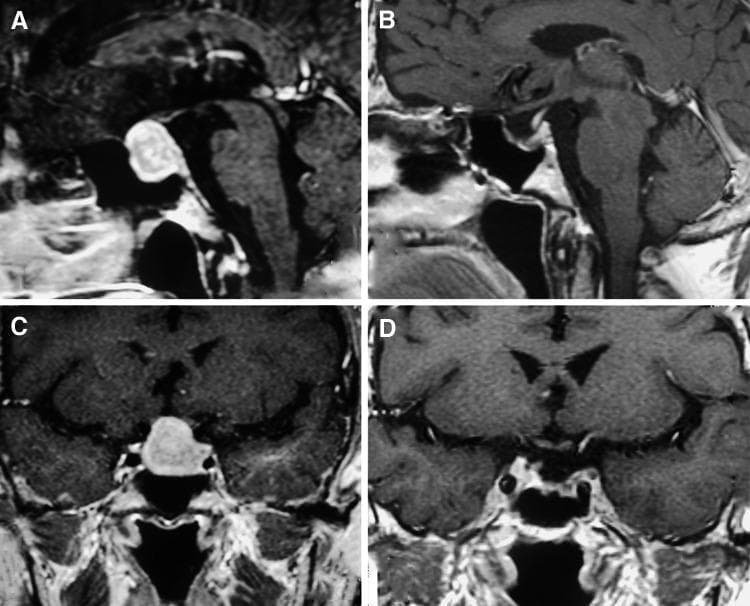 This diagnostic image provides a comparison of pre-operative and post-operative MRI scans showing a TSH-secreting pituitary adenoma. Panels A (sagittal) and C (coronal) display a well-defined, hyperintense oval mass within the sella turcica. The adenoma demonstrates significant suprasellar extension, causing superior displacement of the optic chiasm and narrowing the suprasellar cistern. Panels B (sagittal) and D (coronal) show the same anatomical regions following surgical intervention. These images demonstrate a gross total resection of the adenoma, characterized by the absence of the previously seen hyperintense mass and the restoration of normal anatomical contours in the pituitary region. Visible landmarks include the sphenoid sinus, brainstem, and ventricles. This comparison serves as an educational tool for identifying pituitary macroadenomas and assessing surgical outcomes in neuroendocrinology. Target audience: medical students and neurology residents.