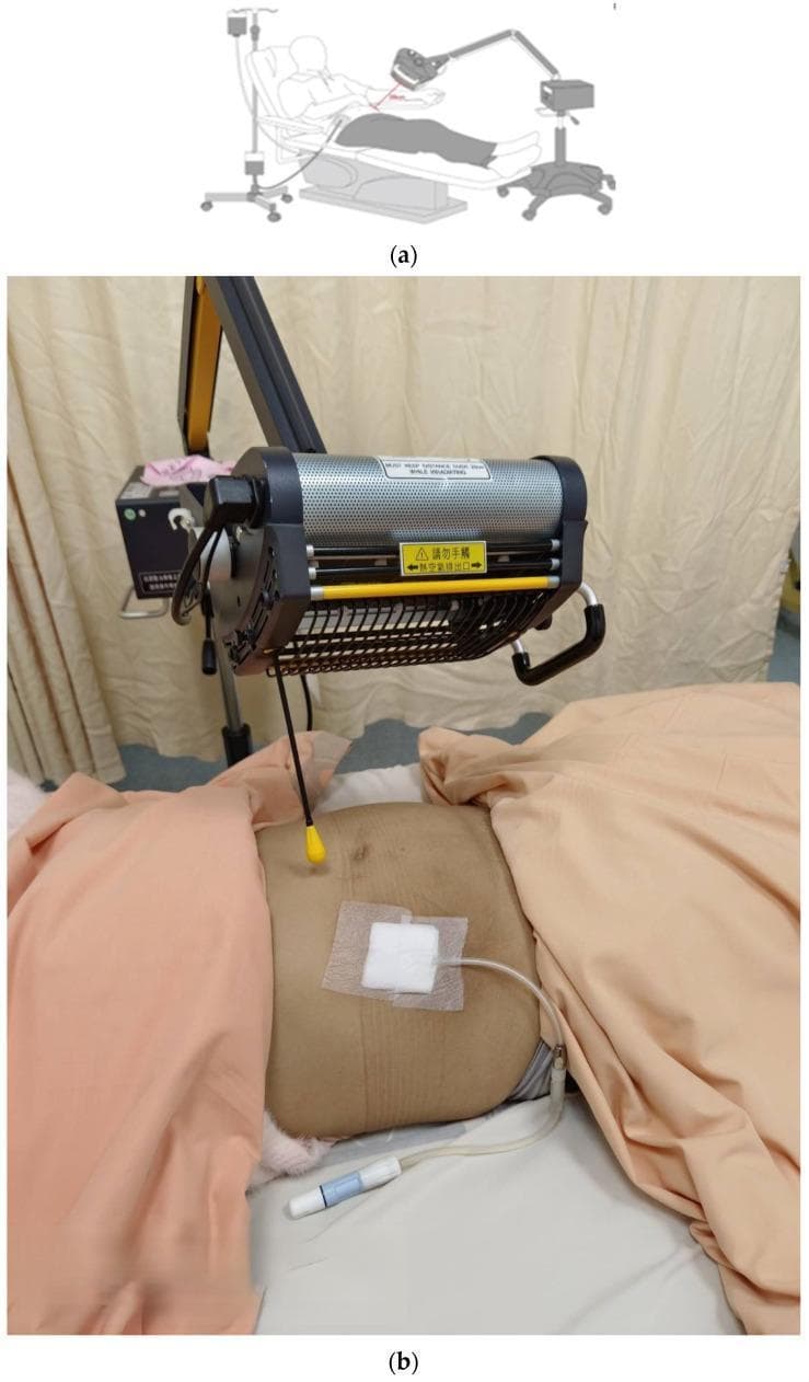 Educational panel illustrating far-infrared (FIR) therapy in a patient undergoing peritoneal dialysis (PD). Part (a) is a schematic diagram showing a patient in a reclined position with a PD bag system and an FIR emitter positioned over the abdomen on an adjustable arm. Part (b) is a clinical photograph showing the real-world application. A patient is supine with the abdomen exposed, featuring a PD catheter exit site secured with a square sterile bandage. The catheter tube connects to a blue-and-white lure lock connector on the bed sheet. Suspended approximately 25 cm above the umbilical region is a WS TY301 FIR emitter, a cylindrical device with a perforated metallic surface for heat dissipation and a yellow safety warning label. The setup demonstrates a clinical trial protocol aimed at studying the effects of FIR radiation on abdominal cavity inflammation and dialysis efficiency. Key concepts include nephrology, home dialysis support, and adjunctive thermal therapy.