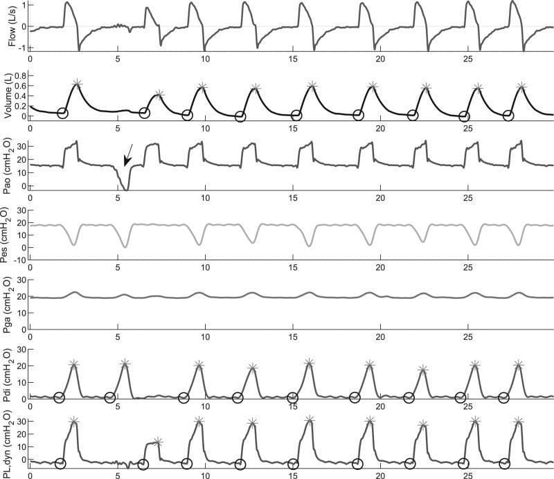 This physiological tracing displays a multi-panel time-series graph of respiratory mechanics during mechanical ventilation. The x-axis represents time in seconds (0-30s), while the y-axes represent various parameters: Flow (L/s), Volume (L), Airway Opening Pressure (Pao, cmH2O), Esophageal Pressure (Pes, cmH2O), Gastric Pressure (Pga, cmH2O), Transdiaphragmatic Pressure (Pdi, cmH2O), and Dynamic Transpulmonary Pressure (PL,dyn, cmH2O). The flow signal shows typical cyclical inspiratory and expiratory phases. The volume, Pdi, and PL,dyn panels feature automated markers: circles indicate the minimum values (end-expiration) and asterisks indicate maximum values (end-inspiration) for each breath. An end-expiratory occlusion maneuver is visible at approximately 5 seconds, indicated by a downward deflection in Pao and Pes to confirm catheter placement. This diagnostic visualization is used in critical care settings to assess patient-ventilator synchrony, work of breathing, and diaphragm-protective ventilation strategies by calculating pressure swings (delta) and transdiaphragmatic effort.