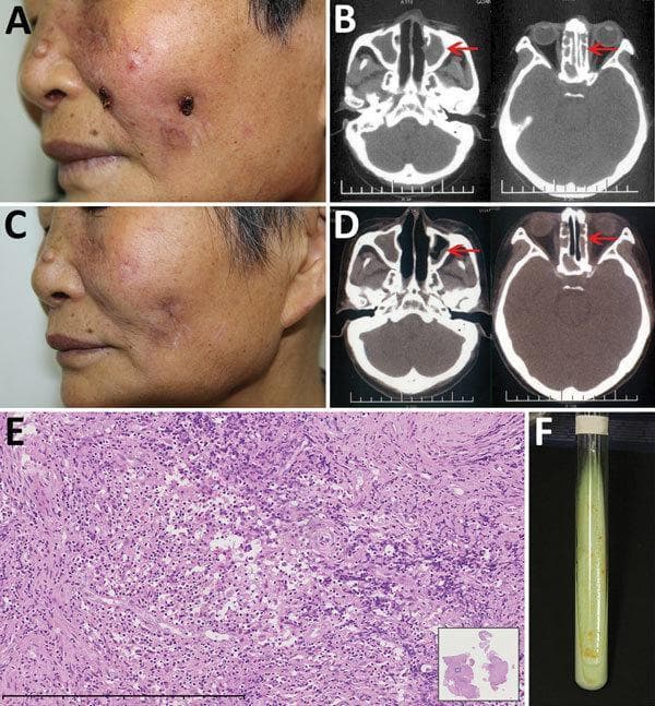 A multi-panel figure illustrating a case of Mycobacterium gordonae infection in an immunocompetent adult. Panel A presents a clinical photograph of the face showing erythematous facial ulcers with central yellow crusting on the cheek. Panel B shows axial CT scans of the paranasal sinuses with arrows indicating opacification and heterogeneous hypersignal in the ethmoid and left maxillary sinuses, consistent with infectious sinusitis. Panels C and D demonstrate clinical and radiological resolution post-treatment, showing atrophic scarring and re-aeration of the previously affected sinuses. Panel E displays a histopathological section (H&E stain) of the nasal mucosa at 20x magnification, revealing dense inflammatory infiltration composed of lymphocytes, histiocytes, and plasma cells. Panel F illustrates a microbiological tissue culture in a Löwenstein–Jensen medium slant, showing characteristic smooth, yolk-yellow pigmented colonies of M. gordonae after 3 weeks of incubation. This educational composite highlights the diagnostic triad of clinical dermatology, radiology, and microbiology in non-tuberculous mycobacterial infections.