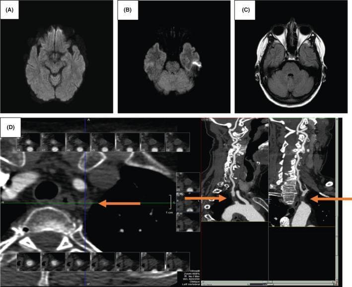 A multi-panel diagnostic imaging study comprising MRI of the brain and CTA of the neck. Panels (A) and (B) show axial Diffusion-Weighted Imaging (DWI) sequences of the brain parenchyma, demonstrating normal signal intensity without evidence of restricted diffusion or acute ischemic stroke in the posterior circulation. Panel (C) is an axial T2-FLAIR sequence showing no hyperintense lesions or edema in the cerebellum or brainstem. Panel (D) features a Computed Tomography Angiogram (CTA) of the neck in axial and sagittal reformats. Orange arrows highlight a complete occlusion of the left subclavian artery. The blockage is located distally to the vessel's aortic origin and proximally to the origin of the left vertebral artery. This clinical finding is significant for the evaluation of subclavian steal syndrome in patients presenting with vertebrobasilar insufficiency symptoms such as vertigo and ataxia.