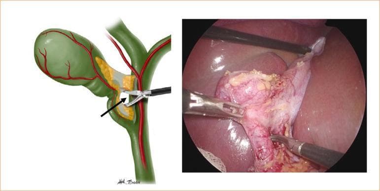 This composite image features an anatomical diagram and a corresponding laparoscopic photograph illustrating the 'critical view of safety' during a cholecystectomy. The diagram on the left shows the gallbladder, cystic duct, cystic artery, and common bile duct with an arrow pointing to a gap created by a Maryland-type dissector. The right panel displays a real-world surgical field of view. It depicts the gallbladder infundibulum being retracted and dissected. A Maryland-type laparoscopic forceps is visible, performing blunt dissection to separate the cystic duct from the cystic artery within Calot’s triangle (the hepatocystic triangle). The gallbladder tissue shows signs of inflammation and surface vascularization, consistent with acute cholecystitis. The procedure focuses on clearing the hepatocystic triangle of fat and fibrous tissue to clearly identify the two, and only two, structures entering the gallbladder, a vital step to prevent iatrogenic bile duct injuries. This resource is intended for surgical residents and medical students studying minimally invasive hepatobiliary surgery.