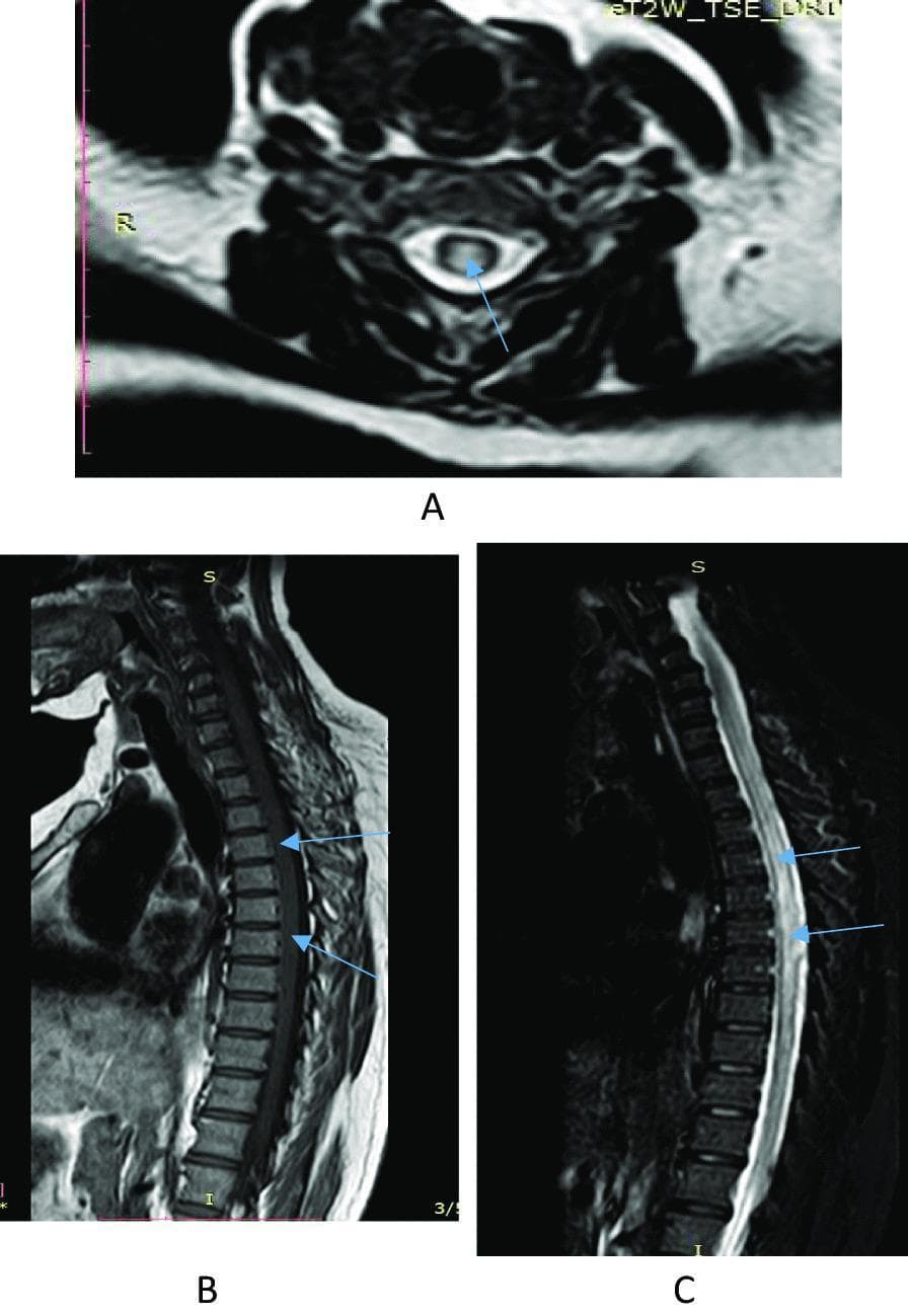 Diagnostic Magnetic Resonance Imaging (MRI) of the cervicothoracic spine demonstrating a longitudinally extensive transverse myelitis (LETM). Panel A (axial T2-weighted image) shows a central hyperintense lesion within the spinal cord parenchyma, occupying more than 50% of the cross-sectional area. Panel B (sagittal T1-weighted image) reveals an expansible, hypointense lesion extending along a long segment of the spinal cord from the cervical (C3) to the lower thoracic (T12) levels. Panel C (sagittal STIR/T2-weighted image) highlights the heterogeneously hyperintense signal within the same segment, indicating significant intramedullary edema or inflammation. The extensive nature of the lesion, spanning more than three vertebral segments, is characteristic of Neuromyelitis Optica Spectrum Disorder (NMOSD) or acute transverse myelitis. This imaging illustrates key diagnostic features for neuroinflammatory demyelinating conditions of the central nervous system.