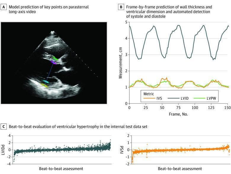 This composite educational image illustrates automated deep learning assessments of cardiac dimensions using echocardiography. Panel A displays a grayscale transthoracic echocardiogram in a parasternal long-axis (PLAX) view. It features overlaid colored landmark points and a measurement vector identified by AI to segment the intraventricular septum (IVS), left ventricular internal dimension (LVID), and left ventricular posterior wall (LVPW). Visible structures include the left ventricle, aortic root, and mitral valve. Panel B is a time-series line graph tracking cardiac measurements in centimeters across approximately 150 video frames. It shows cyclical oscillations corresponding to the cardiac cycle for LVID (dark blue), IVS (orange), and LVPW (green), demonstrating automated detection of systolic and diastolic phases. Panel C presents two waterfall scatter plots showing beat-to-beat evaluation of ventricular hypertrophy across a large dataset. The plots display individual measurement variations for diastolic left ventricular internal dimension (LVIDd) and diastolic intraventricular septum (IVSd). This figure demonstrates the clinical application of AI in high-throughput, automated screening for conditions like hypertrophic cardiomyopathy and cardiac amyloidosis.