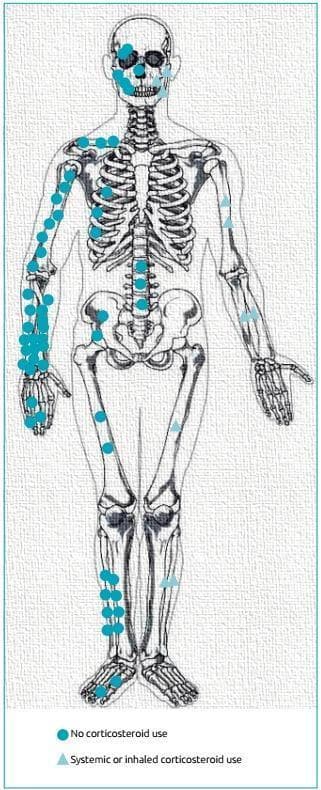 This Comparison Chart consists of an anatomical diagram of a human skeleton, functioning as a fracture topography map. It illustrates the distribution of fracture sites categorized by glucocorticoid (GC) exposure. The educational focus is on identifying patterns of skeletal fragility associated with steroid use. Teal circles represent patients with 'No corticosteroid use,' showing a high density of fractures in the distal forearm (radius/ulna), humerus, ribs, lumbar vertebrae, and lower extremities (tibia, fibula, and phalanges). Teal triangles represent patients with 'Systemic or inhaled corticosteroid use,' highlighting a specific concentration of fractures in the facial bones and proximal humerus. This visualization serves as a clinical epidemiological tool to compare fracture prevalence and anatomical localization between control groups and those at risk for glucocorticoid-induced osteoporosis. The diagram effectively demonstrates that while the distal forearm is the most frequent fracture site overall, steroid users may exhibit distinct patterns in facial and humeral involvement, emphasizing the clinical importance of monitoring skeletal health in patients on GC therapy.