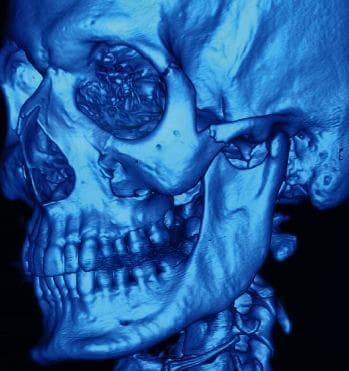 This diagnostic image is a 3D CT reconstruction of a human skull, presented in a monochromatic blue filter, illustrating a complex left zygomatic complex (tripod) fracture. The visualization clearly demonstrates cortical discontinuity and displacement at several key anatomical junctions: the frontozygomatic suture along the lateral orbital rim, the zygomaticomaxillary suture at the inferior orbital rim and anterior maxillary wall, and the zygomaticotemporal suture (zygomatic arch). There is visible disruption of the orbital floor. Adjacent structures including the mandible, maxilla, and dentition appear intact without gross secondary fractures. This image is clinically significant for maxillofacial trauma education, highlighting the structural collapse and multi-point separation characteristic of high-impact zygomatic injuries, often associated with clinical findings like enophthalmos and diplopia.