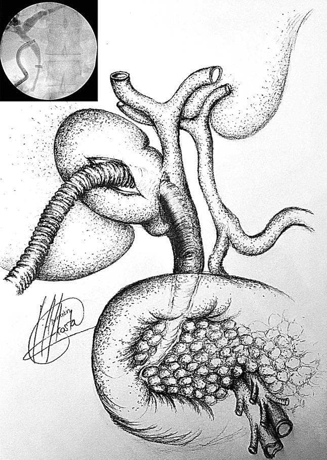 This composite educational image illustrates the surgical management of complex biliary disease, specifically Mirizzi syndrome with a cholecystobiliary fistula. The primary anatomical diagram depicts a gallbladder densely packed with multiple small, uniform stones (cholelithiasis). The biliary tree is shown with the right and left hepatic ducts joining into the common hepatic duct, which then becomes the common bile duct (CBD). A critical feature illustrated is a cholecystobiliary fistula—an abnormal connection between the gallbladder infundibulum and the CBD. A flexible medical device, representing a choledochoscope or cholangiocatheter, is shown entering through the gallbladder infundibulum and traversing the fistula to access the CBD for stone clearance. The upper-left inset contains a diagnostic fluoroscopic image from an intraoperative cholangiogram (IOC). This radiograph confirms the biliary anatomy, showing a radiopaque cholangiocatheter with a curved configuration positioned within the ductal system to assess patency and locate impacted stones. The image serves as a pedagogical tool for understanding the transinfundibular approach in laparoscopic biliary surgery when hilar inflammation is severe.