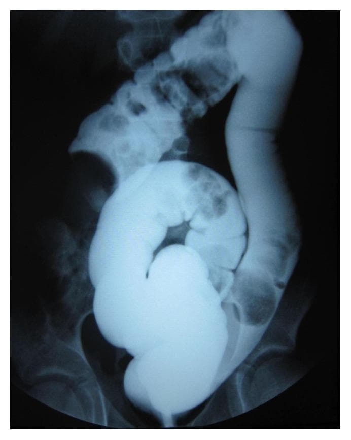 This abdominal X-ray radiography captures a diagnostic barium contrast enema procedure in a pediatric patient. The imaging modality highlights the colon using radiopaque contrast material, demonstrating an unsuccessful hydrostatic reduction of an ileocolic intussusception. A prominent, rounded, and lobulated filling defect is visible in the right upper quadrant, representing the intussusceptum (the prolapsed segment of the bowel) nested within the intussuscipiens. Proximal to this obstruction, the contrast distribution is irregular and narrowed. Distal to the lesion, the barium pools within the sigmoid colon and rectum, which are positioned over the pelvic bones. The image illustrates the classic 'coiled spring' or 'cup-shaped' sign typical of intussusception on contrast studies. This educational visual is highly relevant for pediatric radiology and surgery, focusing on the diagnosis of intestinal obstruction and malrotation-associated complications like Ladd's bands which may contribute to such clinical presentations.