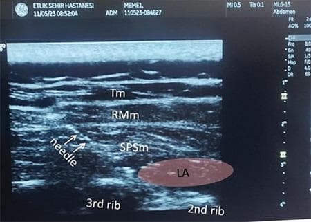 This diagnostic ultrasound image demonstrates a Serratus Posterior Superior Intercostal Plane (SPSIP) block, an ultrasound-guided regional anaesthesia technique. The scan, captured in the sagittal plane along the medial border of the scapula, shows the layered musculature of the upper back. From superficial to deep, the labeled structures include the trapezius muscle (Tm), rhomboid major muscle (RMm), and the serratus posterior superior muscle (SPSm). Deep to these muscles, the hyperechoic surfaces of the 2nd and 3rd ribs are visible with characteristic acoustic shadowing. A needle is visualized approaching the fascial plane. A hypoechoic (dark) oval region labeled 'LA' indicates the successful infiltration and spread of local anaesthetic between the serratus posterior superior muscle and the underlying intercostal space/ribs. This image serves as a clinical guide for identifying target anatomical planes for postoperative analgesia in thoracic or shoulder surgeries.