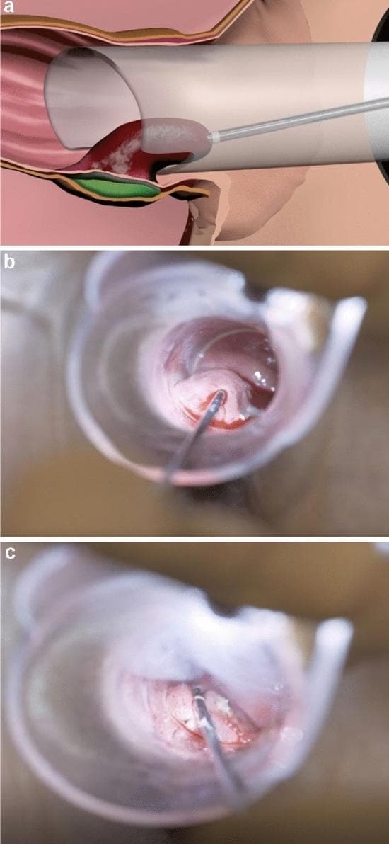 This composite visual represents the Rafaelo® procedure for the treatment of internal hemorrhoids using radiofrequency ablation. Panel (a) is a schematic diagram illustrating the anatomical positioning: a proctoscope is inserted into the anal canal, through which a radiofrequency probe is guided into the hemorrhoidal plexus above the dentate line. A protective layer of local anesthetic is shown injected between the submucosa and the internal sphincter muscle to prevent thermal injury. Panel (b) is a clinical photograph taken via proctoscopy showing the real-time insertion of the fine-needle probe tip into the protruding hemorrhoidal tissue. Panel (c) demonstrates the post-ablation state of the tissue. Visible hallmarks of successful treatment include mucosal blanching (lightening of tissue color) and localized coagulation points on the hemorrhoid surface, indicating thermal denaturation of proteins. The procedure aims to induce tissue fibrosis and subsequent retraction of the hemorrhoidal prolapse, minimizing post-operative pain and avoiding open surgical wounds.