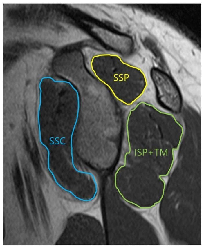 This oblique-sagittal T2 Turbo Spin Echo (TSE) MRI scan demonstrates the musculoskeletal anatomy of the shoulder in a glenoid face view, specifically for assessing the cross-sectional area of the rotator cuff muscles. The image features color-coded annotations outlining the muscular boundaries: the supraspinatus (SSP) is outlined in yellow in the superior position; the subscapularis (SSC) is traced in blue anteriorly; and the infraspinatus combined with the teres minor (ISP+TM) is outlined in green in the posterior-inferior quadrant. The musculature appears as intermediate to dark gray signal intensity, allowing for the evaluation of muscle volume and potential fatty infiltration or atrophy. This imaging view is clinically significant for orthopedic evaluation and preoperative planning in cases of rotator cuff tears or shoulder instability, providing a clear visualization of the muscular support surrounding the glenohumeral joint.