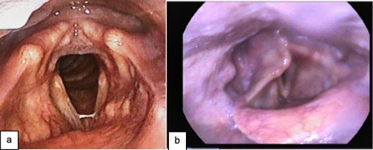 This comparative figure features two laryngeal endoscopic images (a and b) illustrating post-intubation sequelae in adult patients. Image 'a' displays the larynx of a 56-year-old male with thinned vocal folds and a visible fibrous band located mid-right vocal fold; however, the airway remains patent with symmetrical adduction and abduction preserved. Image 'b' shows a 58-year-old male with significant laryngeal structural irregularities, including bilateral vocal fold palsy, right arytenoid prolapse, and posterior glottic stenosis. The vocal folds are shown in maximal abduction, revealing a severely narrowed glottic and subglottic airway due to stenosis. These diagnostic images demonstrate typical late-stage complications of prolonged mechanical ventilation and endotracheal intubation, such as those observed in COVID-19 survivors. The focus is on laryngeal anatomy, vocal fold pathology, and airway patency, serving as an educational resource for speech-language pathology, otolaryngology, and intensive care medicine regarding the detection and classification of laryngeal trauma and stenosis.