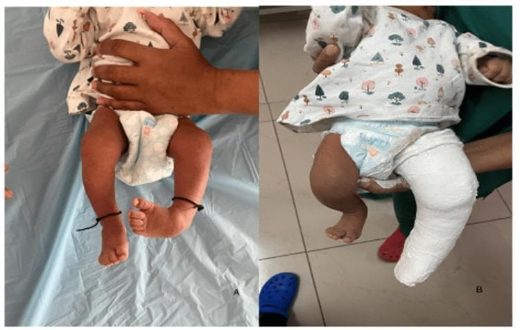 Clinical photographs depicting the management of Congenital Talipes Equinovarus (CTEV), commonly known as clubfoot, using the Ponseti technique. Figure A shows an infant with bilateral clubfoot exhibiting classic deformities: forefoot adduction, hindfoot varus, and equinus. A prominent medial longitudinal arch is visible on the right foot, signifying cavus deformity. Figure B demonstrates the initial phase of serial casting. The left lower extremity is encased in a white, above-knee plaster cast. This first cast is specifically designed to correct the cavus component by supinating the forefoot to align it with the hindfoot while maintaining some abduction. The cast extends from the upper thigh to the toes, which remain visible for neurovascular monitoring. This visual documentation illustrates the step-wise orthopedic correction of neonatal foot deformities through manual manipulation and rigid immobilization.