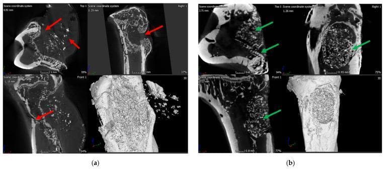 This diagnostic image set consists of Micro-CT (μ-CT) scans and 3D reconstructions of rat tibia used in a bone healing and infection study. Figure (a) illustrates an infection control group exhibiting characteristic signs of osteomyelitis. Red arrows highlight significant pathology, including a narrowing of the marrow space, deformed cortical bone, ectopic bone growth, and the presence of a sinus tract associated with a soft-tissue fibrous capsule. These features demonstrate severe osteolysis and disrupted bone architecture common in chronic infection. Figure (b) displays the treatment group using bioactive glass (BG). Green arrows indicate positive regenerative outcomes, specifically the formation of new immature cancellous and cortical bone within the previously drilled defect. The 3D and cross-sectional views show successful osseointegration and structural remodeling, contrasting the pathological destruction in the control group with the regenerative progression in the treatment group. This image is relevant for orthopedic research and the study of antibiotic-eluting bone graft substitutes.