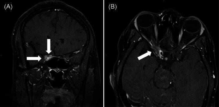 This diagnostic imaging composite features two magnetic resonance imaging (MRI) slices of the skull base and orbits in coronal (A) and axial (B) planes. The images are T1-weighted with contrast enhancement. White arrows indicate pathological findings concentrated in the right cavernous sinus and petrous apex regions. In the coronal view (A), hyperintense (bright) signal enhancement is visible within the right cavernous sinus, extending towards the orbital apex, contrasting with the normal appearance of the contralateral side. In the axial view (B), the arrow highlights abnormal enhancement and soft tissue thickening involving the right cavernous sinus and adjacent structures medial to the temporal lobe. Anatomical landmarks include the orbits, globe, sphenoid sinus, and brain parenchyma. The visual evidence of idiopathic granulomatous inflammation in this specific neuroanatomical location is highly characteristic of Tolosa-Hunt syndrome, a clinical entity associated with painful ophthalmoplegia. This educational material is relevant for neuroradiology and ophthalmology, illustrating diagnostic findings for cavernous sinus syndrome and cranial nerve palsies.