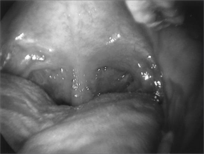 This clinical photograph provides an endoscopic view of the pharynx during inspiration, illustrating dynamic airway changes. The base of the tongue is positioned anteriorly in the lower foreground. The posterior pharyngeal wall is clearly visible, flanked by lateral pharyngeal walls that exhibit significant medial contraction, leading to a narrowing of the oropharyngeal space. Superiorly, the soft palate and uvula are visible. Deep within the airway, the laryngeal inlet is partially obscured, with the glottic opening appearing inappropriately constricted during the inspiratory phase. This presentation is characteristic of paradoxical laryngeal movement and pharyngeal dystonia, where the pharyngeal and laryngeal structures abnormally adduct during inhalation, causing upper airway obstruction. The mucous membranes appear moist and physiologically normal in texture, though the overall pharyngeal volume is reduced due to the active muscular constriction shown in this clinical case of respiratory-related dystonia.
