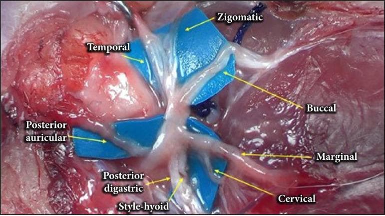 This clinical photograph displays a high-magnification surgical dissection of the facial nerve (Cranial Nerve VII) and its extratemporal branches. The image highlights the anatomical arrangement after the parotid gland has been removed. Blue surgical background material is placed beneath the nerves to enhance visual contrast. Visible and labeled branches radiating from the main trunk include the temporal, zygomatic, buccal, marginal mandibular, and cervical branches. Additionally, the posterior auricular branch is visible posteriorly, while the posterior digastric and stylohyoid branches are shown inferiorly. The branches appear as glistening, whitish-cord structures overlying surrounding muscle and connective tissue. This educational visual demonstrates the typical branching patterns and spatial relationships essential for parotidectomy procedures, maxillofacial surgery, and head and neck anatomy education. The labels indicate the specific distribution of motor innervation to the muscles of facial expression.