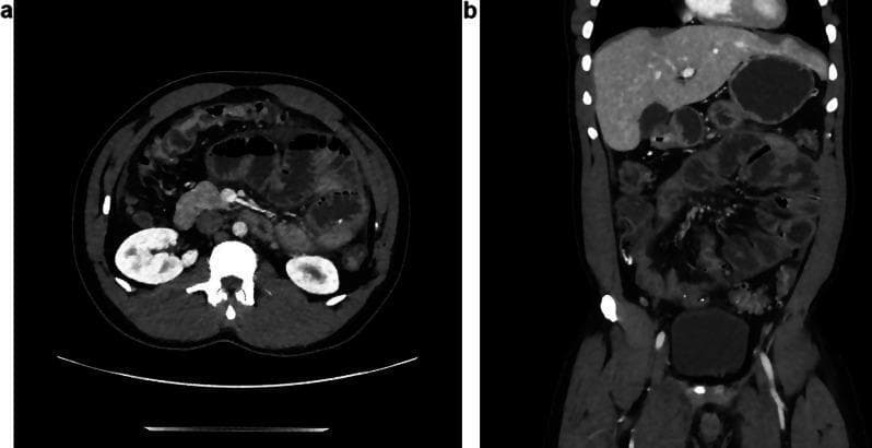 Abdominal Computed Tomography (CT) scan presented in axial (a) and coronal (b) planes, demonstrating features of a chronic inflammatory process and mechanical bowel obstruction. The images reveal significant distension of multiple small bowel loops, consistent with a paralytic ileus or encapsulating peritoneal sclerosis. A key diagnostic feature is the peripheral 'cocooning' or 'shelling' of the intestinal loops by a thickened peritoneum. The coronal view highlights a disorganized clustering of the dilated jejunal loops within the central abdomen. While there is evidence of intra-abdominal effusion (ascites), the volume appears reduced compared to typical acute peritonitis, suggesting a maturing fibro-inflammatory process. There are visible signs of peritoneal thickening and mesenteric fat infiltration. This clinical presentation, in the context of progressive abdominal pain, is highly suggestive of Abdominal Cocoon Syndrome (sclerosing encapsulating peritonitis), which in this immunocompetent patient was secondary to peritoneal histoplasmosis.