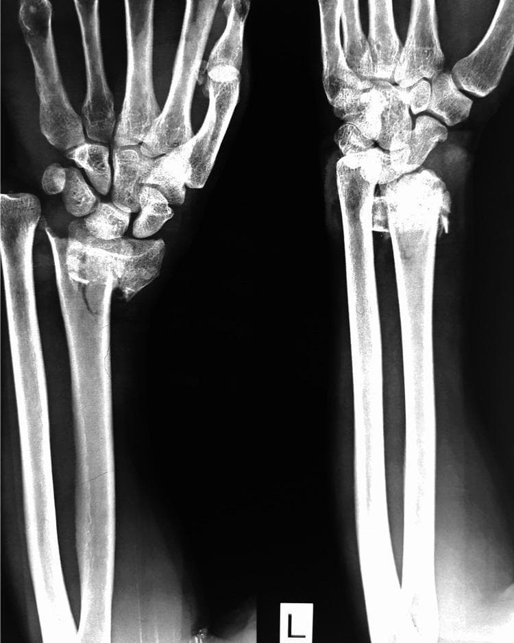 This diagnostic image is a plain radiograph (X-ray) of the left wrist in two views (oblique and lateral) demonstrating a complex distal radius fracture. The visual evidence shows a comminuted fracture of the distal radial metaphysis with intra-articular extension. Key pathological features include significant radial shortening, dorsal displacement, and dorsal angulation of the distal fracture fragments (characteristic of a Colles-type injury pattern). The alignment of the radiocarpal joint is disrupted, with the carpal bones shifted dorsally in relation to the main radial shaft. There is visible fragmentation and irregularity at the fracture site, indicating instability. The distal ulna appears intact, though the distal radioulnar joint (DRUJ) relationship is altered due to the radial shortening. This image illustrates a common orthopedic trauma scenario requiring surgical evaluation for anatomic reduction and stabilization, often via external fixation or internal plate osteosynthesis.