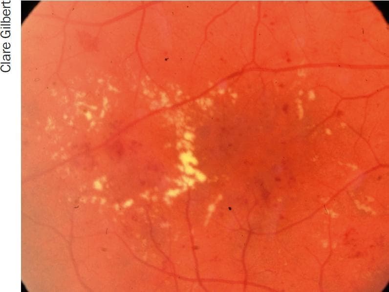 This clinical photograph of a human fundus illustrates hard exudates in a circinate pattern, a classic finding in diabetic retinopathy. The image shows numerous small, yellowish-white, well-defined deposits of lipid and protein within the retina. These exudates are arranged in a roughly circular or ring-like (circinate) formation, often indicating a central cluster of leaking microaneurysms or damaged retinal capillaries. The background retina appears reddish-orange with visible branching retinal vasculature. In addition to the hard exudates, subtle dark red spots are visible, representing intraretinal hemorrhages or microaneurysms. This visual is characteristic of clinically significant macular edema or non-proliferative diabetic retinopathy, where chronic vascular permeability leads to the accumulation of these lipoprotein residues. The contrast between the bright, refractile exudates and the darker retinal background highlights the pathological distribution useful for teaching diagnostic ophthalmology and diabetic eye disease management.