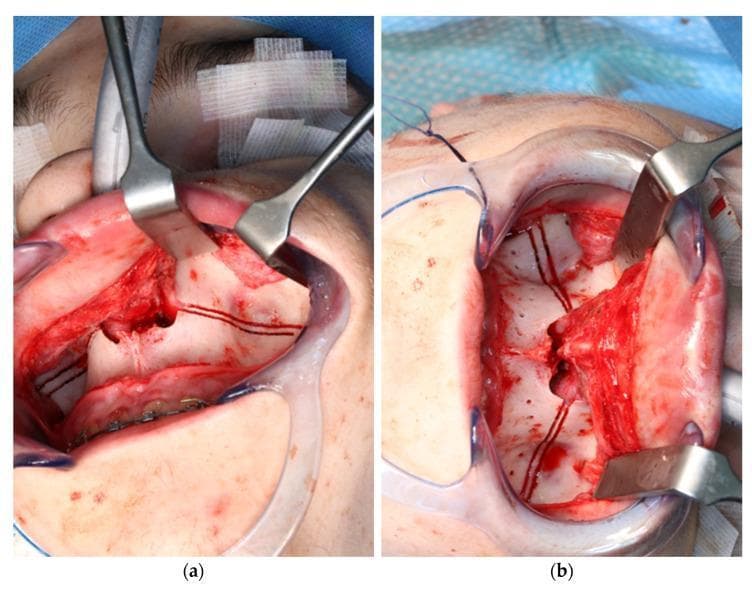 Side-by-side intraoperative clinical photographs documenting a Le Fort I osteotomy procedure using robotic laser guidance. Both images show a wide surgical exposure of the maxilla with a vestibular incision and mucoperiosteal flap elevation, maintained by surgical retractors. Image (a) demonstrates the pre-drilling phase, where the robot-guided laser (CARLO system) has accurately marked the planned osteotomy line and specific locations for patient-specific implant (PSI) drill holes, indicated by precise black thermal markings on the cortical bone. Image (b) shows the subsequent phase after a conventional rotating handpiece was used to create the physical drill holes following the laser-marked guides. The bone surface in (b) exhibits focal bleeding and structural disruption at the drill sites. This comparison illustrates the clinical application of laser-guided navigation to improve the accuracy of surgical planning and execution in orthognathic surgery for skeletal malocclusion.