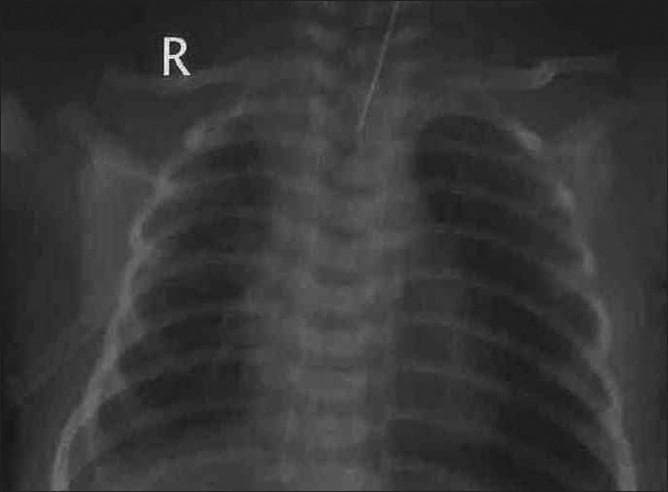 This diagnostic image is a neonatal anteroposterior (AP) chest radiograph illustrating the status post-drainage of a pleural effusion. The image shows full expansion of both lung fields with symmetric aeration and visible bronchovascular markings. The trachea is centrally located and midline, and the mediastinal shift previously caused by the effusion has resolved. A radiopaque intercostal chest tube is visible, originating from the right hemithorax and positioned within the pleural space to facilitate drainage. The costophrenic angles and diaphragmatic contours are visible, indicating successful re-expansion. This radiograph serves as a clinical example of post-procedural monitoring in neonatal respiratory distress management, specifically demonstrating the effective resolution of a large unilateral pleural effusion and the resulting restoration of normal pulmonary volume and thoracic symmetry.
