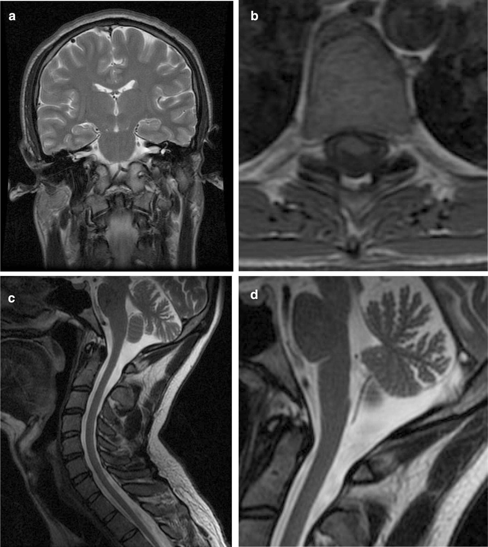 This composite of four MRI images displays neuroanatomical findings in a patient with spinocerebellar ataxia. Image (a) is a T2-weighted coronal section showing normal brain parenchyma, brainstem, inner ears, and vestibulocochlear nerves. Image (b) is a T1-weighted axial section of the dorsal spine, illustrating significant anteroposterior flattening of the spinal cord. Image (c) presents a T2-weighted sagittal view of the head and neck, demonstrating marked cervical kyphosis and both cervical spinal cord and cerebellar atrophy. Image (d) provides a high-magnification sagittal detail of the cerebellum, highlighting prominent folia and widened sulci indicative of cerebellar atrophy. These findings are clinically relevant for diagnosing syndromic neurological conditions such as Perrault syndrome or other spinocerebellar degenerations involving mitochondrial dysfunction.
