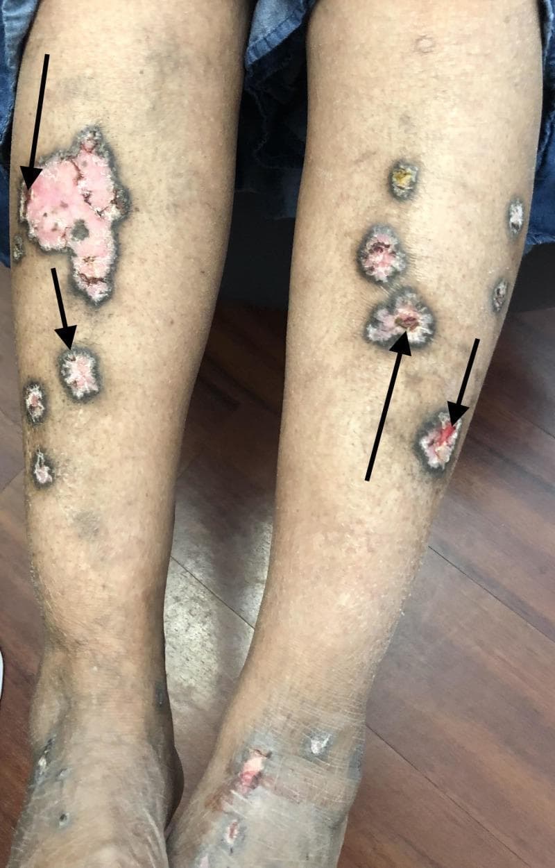 A clinical photograph of the lower extremities of a 63-year-old patient demonstrating hypertrophic lichen planus. The image shows multiple, well-circumscribed, pink-to-violaceous hypertrophic plaques distributed over the distal shins and dorsal feet. Key morphological features include a prominent border of peripheral hyperpigmentation and central areas of ulceration, as indicated by black arrows. The ulcerated regions reveal raw, erythematous tissue with focal loss of the epidermal barrier. The non-ulcerated portions of the plaques appear thickened with a rough, verrucous texture. These findings are characteristic of the hypertrophic variant of lichen planus, emphasizing the chronic, inflammatory nature of the disease and its potential for ulceration. The presentation serves as an educational example for dermatological diagnosis, highlighting the hallmark features of plaque morphology, pigmentary changes, and tissue erosion in a typical anatomical distribution.