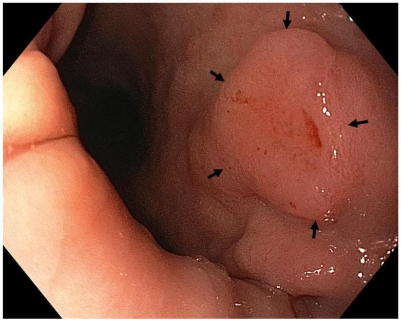 This High-Definition White Light Endoscopy (WLE) image displays a prominent gastric lesion located in the antrum. The content demonstrates clinical findings of early gastric cancer, specifically a moderately differentiated intramucosal adenocarcinoma categorized as Paris classification 0-IIb. The primary lesion is an elevated, rounded, pinkish mass with relatively well-defined margins indicated by black arrows. The surface of the mass exhibits subtle irregularities and focal areas of erythema, including small red streaks and spots suggestive of spontaneous oozing or hypervascularity. The surrounding gastric mucosa shows signs of autoimmune gastritis with atrophy, characterized by a paler pink hue and a smoother texture compared to the neoplastic lesion. This diagnostic image serves as an educational example for identifying precancerous and early neoplastic changes in the stomach, highlighting the transition from atrophic gastritis to intestinal-type adenocarcinoma.