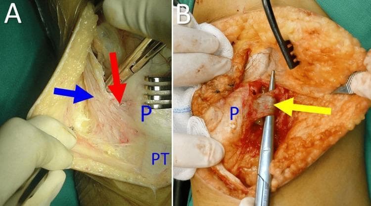 This surgical clinical photograph, divided into two panels (A and B), demonstrates the anatomical structures of the lateral patellar retinaculum during a knee procedure. In Panel A, a blue arrow identifies the iliotibial tract (ITB), shown as a broad fibrous band. A red arrow indicates the iliopatellar band (IPB), which branches from the ITB and inserts obliquely onto the lateral aspect of the patella (labeled 'P'). The patellar tendon ('PT') is visible inferiorly. Panel B shows a deeper dissection where a yellow arrow points to the lateral patellofemoral ligament (LPFL), isolated by a surgical instrument. The LPFL is characterized as a distinct capsular thickening located deep to the IPB, originating near the lateral femoral epicondyle and inserting on the middle third of the lateral patella. These images are intended for educational instruction on patellofemoral joint stability and the surgical anatomy relevant to treating patellar dislocation or instability.