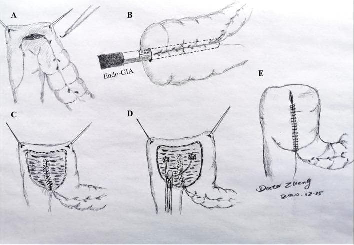 This medical schematic diagram illustrates the sequential surgical steps for creating a colonic urinary reservoir (neobladder) following a radical cystectomy. The procedure is depicted in five stages: Step A shows the initial antimesenteric incision in a folded segment of the sigmoid colon or rectum using electrocautery and stay sutures. Step B demonstrates the introduction of a laparoscopic Endo GIA stapler into the lumen for detubularization. Step C reveals the internal surface of the opened bowel segment with visible staple lines along the medial edges. Step D illustrates the implantation of bilateral ureteric stents into the reservoir, establishing an anti-reflux mechanism. Finally, Step E shows the completed pouch after the anterior seromuscular wall has been closed with continuous or interrupted sutures, transforming the tubular intestine into a wide, reservoir-like structure. This illustration serves as an educational tool for urological surgeons to understand the intraluminal stapling technique and detubularization logic required for urinary diversion.