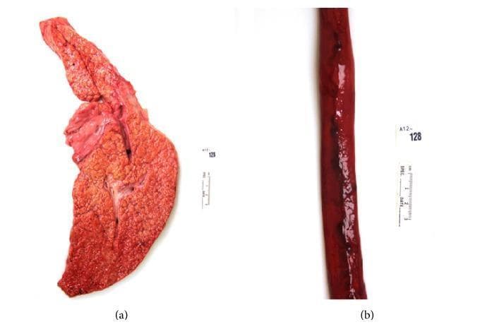 This composite of two clinical photographs illustrates the gross pathology of end-stage liver disease and its complications. Figure (a) displays a gross specimen of a human liver exhibiting cirrhosis, likely secondary to chronic hepatitis C. The organ shows a distorted architecture with a diffuse, reddish-brown coloration and a characteristic micronodular surface texture. This 'cobblestone' appearance is indicative of regenerative nodules separated by fibrous septa. Figure (b) shows a longitudinal section of an esophagus with prominent esophageal varices. The varices appear as dark red, dilated, and tortuous venous structures protruding from the esophageal wall. Focal dark areas along the vessels suggest recent hemorrhage or thrombus formation. Together, these images demonstrate the pathophysiology of portal hypertension, where hepatic cirrhosis leads to the development of portosystemic shunts, such as esophageal varices, which are a critical risk factor for life-threatening upper gastrointestinal bleeding.