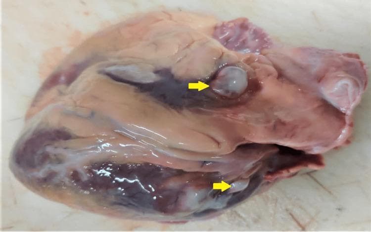 This clinical photograph shows a gross pathological specimen of a human heart during a postmortem examination. The image displays the epicardial surface, with two distinct cystic lesions highlighted by yellow arrows. These lesions appear as smooth, well-circumscribed, translucent to whitish-grey nodules protruding from the myocardium. The superior lesion is located near the base of the heart/left atrium, while the inferior lesion is situated along the ventricular wall. The surrounding cardiac tissue exhibits a mottled reddish-brown appearance with visible coronary grooves and areas of darker venous congestion. There is evidence of epicardial fat and focal pale, fibrous-appearing regions. The pathology is highly characteristic of cardiac cysticercosis, demonstrating the larval stage of Taenia solium (cysticercus cellulosae) embedded within the cardiac structure. This specimen serves as an educational example of parasitic infestation of the cardiovascular system and its macroscopic presentation during autopsy.